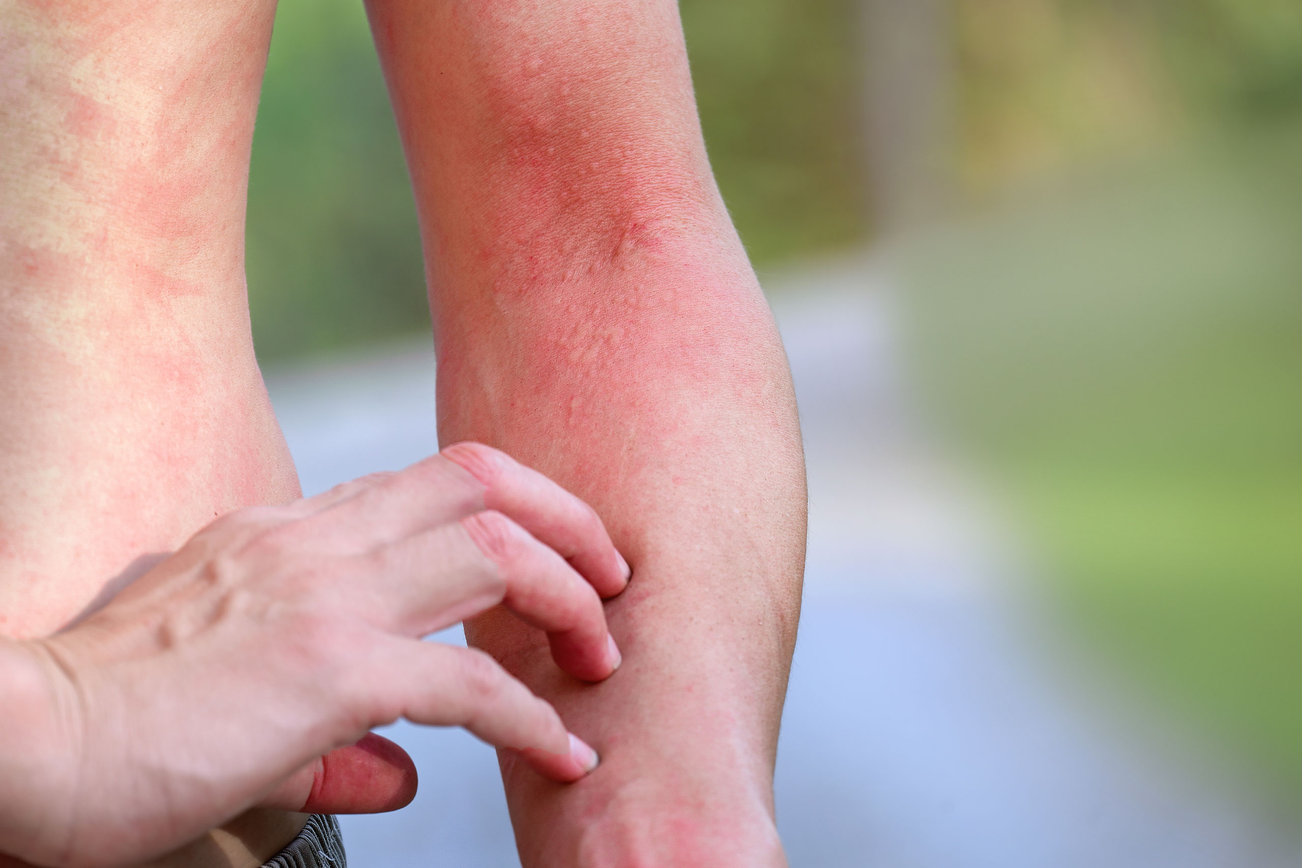 rashes