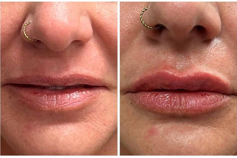 lipfiller