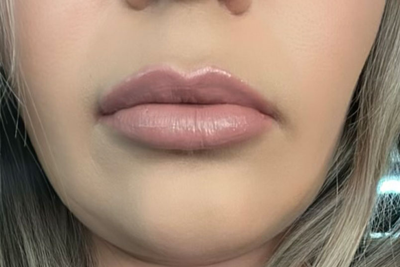 lipfiller2